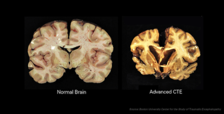 Normal Brain vs. Advanced CTE