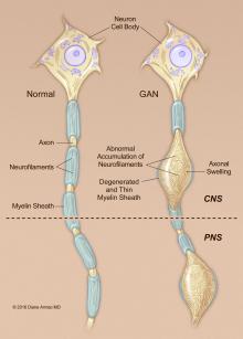 neuron in giant axonal neuropathy compared to normal neuron