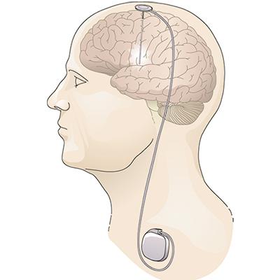 Deep brain stimulation (DBS)