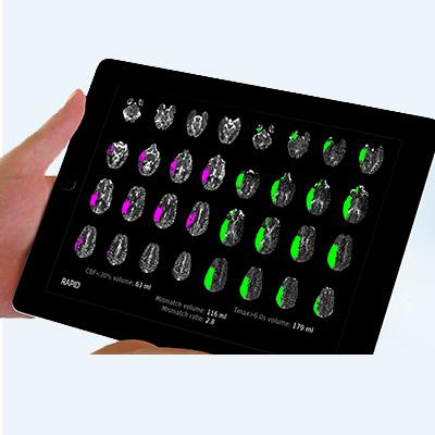 DEFUSE 2 used imaging software developed by the investigators for fast, automated analysis of brain imaging scans49. Courtesy of Greg Albers, MD, Stanford University