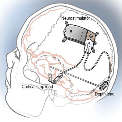 NeuroPace responsive neurostimulation system (RNS). Courtesy NeuroPace, Inc.