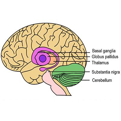 Deep Brain Stimulation (DBS) anatomy. Credit: John Henkel, Food and Drug Administration/Wikimedia Commons/Public Domain