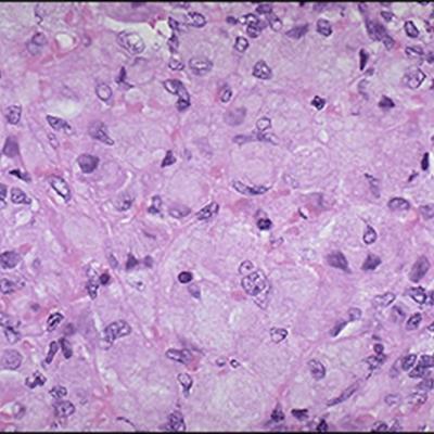 Photo of enzyme glucocerebrosidase localized to lysosomes