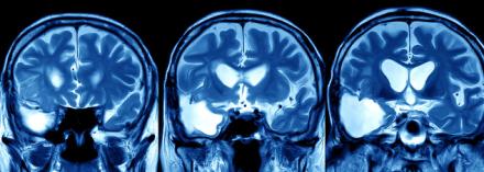 Photo of brain MRI scan. Focus On Traumatic Brain Injury banner image. Credit: Shutterstock