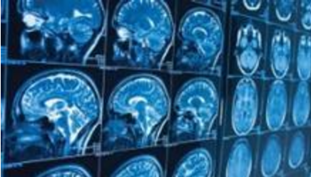 Imágenes por resonancia magnética que muestran cerebros
