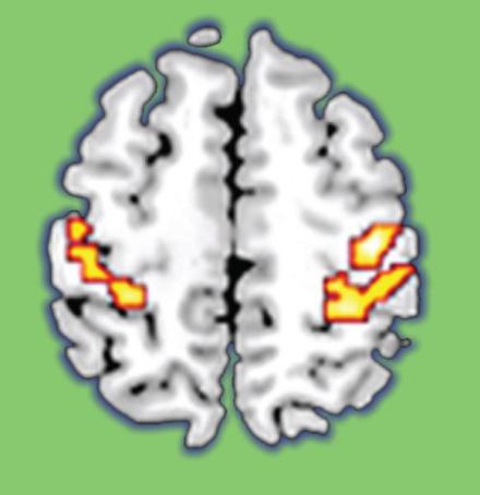 brain with dementia-related areas highlighted