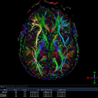 Tractography diffusion tensor imaging mri of the brain