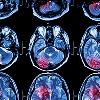 MRI magnetic resonance image of brain