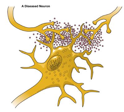 Diseased Neuron