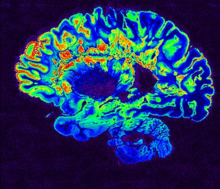 MRI scan
