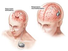 Modified from Edwards CA, Kouzani A, Lee KH, Ross EK. Neurostimulation Devices for the Treatment of Neurologic Disorders. Mayo Clin Proc 2017;92:1427-1444