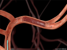 A stent-retriever captures a clot blocking an artery in the brain. Credit: Medtronic
