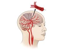 stroke - blood clot