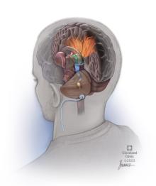 Illustration of a single DBS lead implanted into the cerebellum, with nerve fibers extending from the implant region through the thalamus and into the motor cortex.