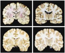 Brain cross-sections show abnormalities associated with CTE (top) compared to a control (bottom)