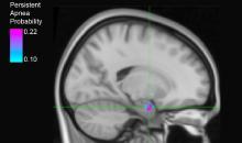 Brain scan of site in amygdala critical to breathing loss after seizure