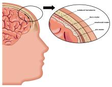 Depiction of the outer layers of the brain. The pia mater is the closest to the brain, followed by the arachnoid mater and the dura mater. A small red area under the dura mater shows a subdural hematoma.