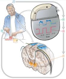 Illustration of deep brain stimulation electrodes within the brain being controlled by a device that monitors brain activity