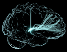 Image showing electrical excitation by deep brain stimulation in human brain