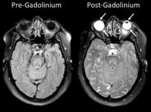 gadolinium seeps into the eyes of acute stroke patients