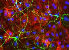 Picture of brain cells grown in a petri dish from a study on how immune cells react to blood leaking into the brain after hemorrhagic stroke. This picture shows that dead red blood cells can kill neurons.