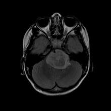 MRI image of a patient with a brain tumor