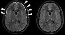 Evidence of repair after head injury in humans