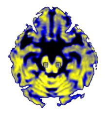 free water image of PD brain