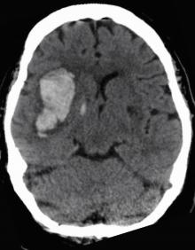 Brain scan showing damage caused by bleeding during a hemorrhagic stroke