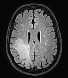 MRI scan showing PML lesions