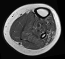 Scan of thigh from an ALS patient. Bone is white. Muscle is grey.