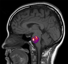 Sideview brain scan in black and white. Cavernous angioma in middle of brain is highlighted in color.