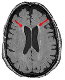 Example of brain scan used in study of blood pressure on brain health.