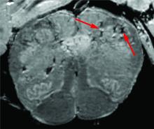 Scan of COVID-19 patient’s brain colored grey. Red arrows point to light and dark spots that are indicative of blood vessel damage observed in an NIH study on how COVID-19 affects the brain.