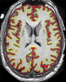 Brain image from multiple sclerosis study