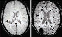 MRIs of healthy (left) and a patient with a mutation that increases CCM formation (right). These lesions can cause blood to leak into the tissue.