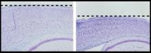 This image compares sections of cortex from a control mouse (left) to a mouse with a presenilin-1 mutation (right). The dashed line indicates the surface of the brain. Presenilin-1 mutations decrease gamma-secretase activity and cause features of neurodeg