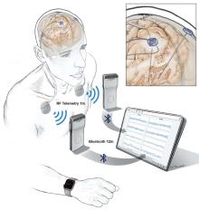 cartoon image showing implanted device in the brain sending wireless signals to a tablet computer