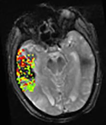 This image combines pre- and post-treatment scans from the same patient. Analysis of the two scans revealed that the area and size of post-treatment bleeding corresponded to blood-brain barrier disruption (shown in green, yellow and red) prior to therapy