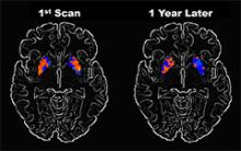 image of two brains from a parkinson's patient: 1 initial scan and another from 1 year later