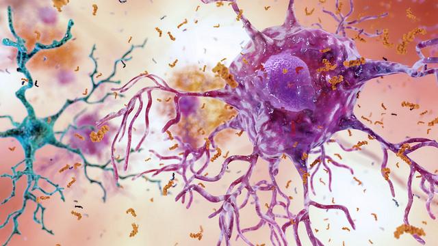 Silent seizures may contribute to cognitive decline in Alzheimer’s disease