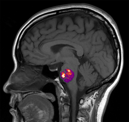 Study ties stroke-related brain blood vessel abnormality to gut bacteria. Nature Communications