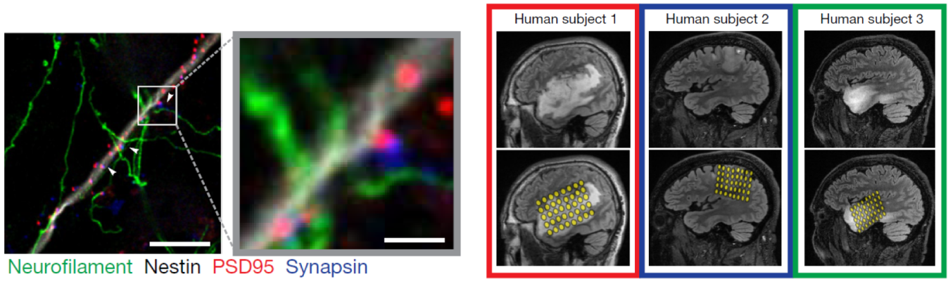 Fluorescent image of synaptic connections between gliomas and neurons in a mouse brain. White box and arrows highlight a region with dense synaptic connections. Green denotes neurofilament (axon); white denotes glioma cell processes; blue denotes synapsin (presynapse); red denotes glioma postsynaptic puncta.