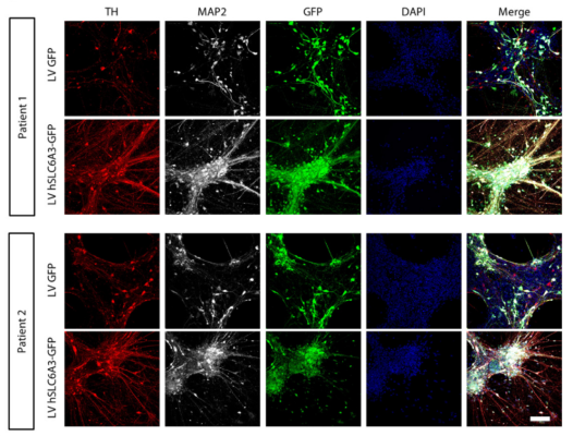 Gene therapy restores missing dopamine in children with rare brain disease