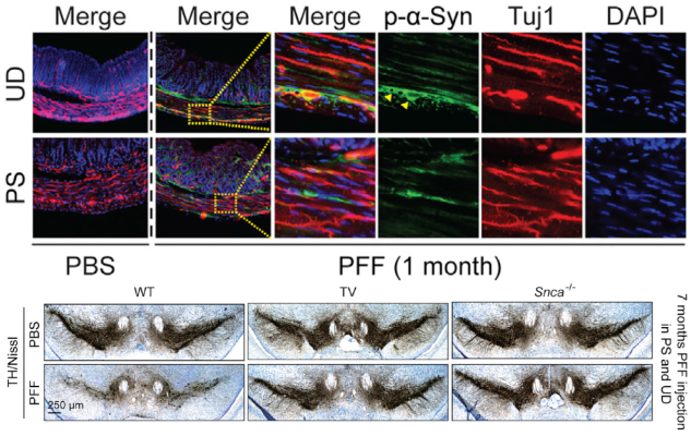 Immunofluorescent image of gut tissue stained for pSer129-a-syn (green) and Tuj-1 (red) – indicators of alpha-syn presence – in the upper duodenum (UD) and pyloric stomach (PS) one-month after alpha-syn injection (top). Photomicrographs from mesencephalon sections containing dopamine (TH-positive) neurons in the substansia nigra pars compacta region seven months after alpha-syn injection into the guts of a healthy (left), vagotomized (middle), and alpha-syn knockout mouse (right) (bottom).