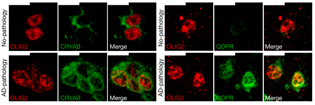 Immunohistochemistry on oligodendrocytes in the white matter of Brodmann area 10 for individuals with no AD pathology (top row) or AD pathology (bottom row). These cell subtypes expressed high levels of QDPR and CRYAB. The latter is an anti-apoptotic and neuroprotective chaperone, the dysfunction of which could exacerbate inflammation and demyelination.