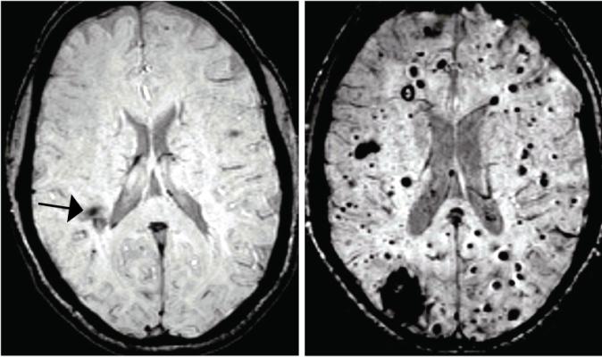 Researchers connect brain blood vessel lesions to intestinal bacteria