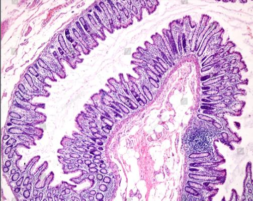 Researchers connect brain blood vessel lesions to intestinal bacteria.
