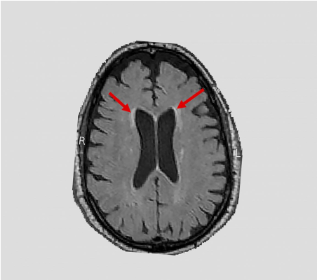 An NIH-funded clinical trial - Systolic Blood Pressure Intervention Trial (SPRINT) - found a link between blood pressure and white matter lesions. Arrows highlight examples of lesions seen on magnetic resonance imaging brain scans. 