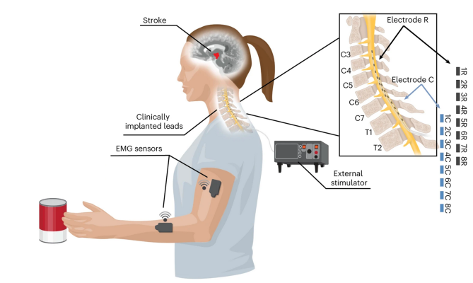 A cartoon representation of a the research setup, showing an individual performing a reaching task. The image depicts the site of stroke in the brain, wireless EMG sensors on the arm and forearm, a depiction of an external stimulator, and an indicator of where leads were implanted. To the upper right is an enlarged image depicting the anatomy of the cervical and thoracic spinal column that depicts the area where each electrode made contact.
